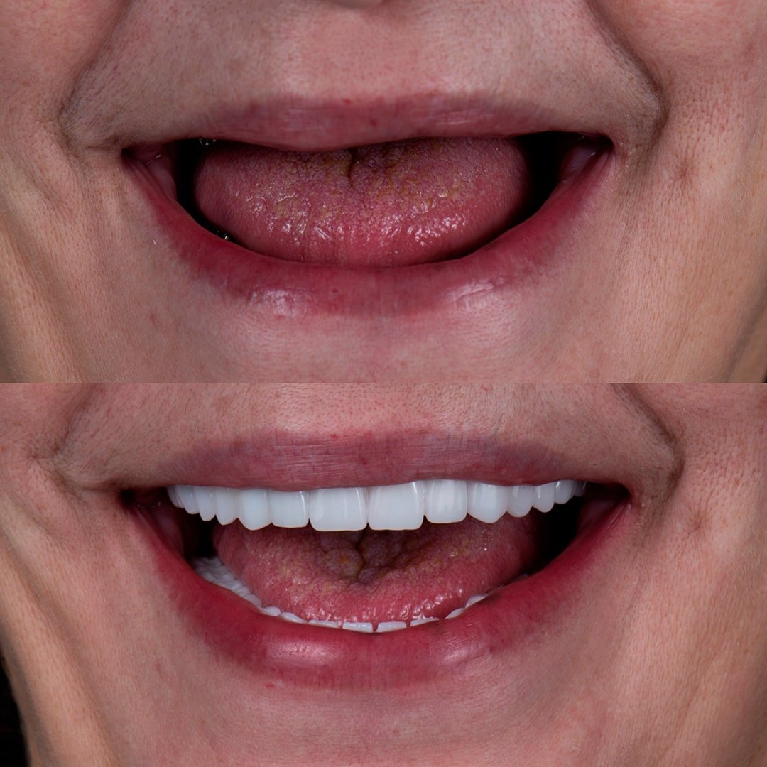Implante Dental - Odontoclinic